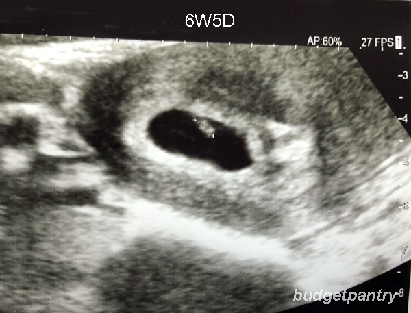 Heartbeat ultrasound 6 week No heartbeat