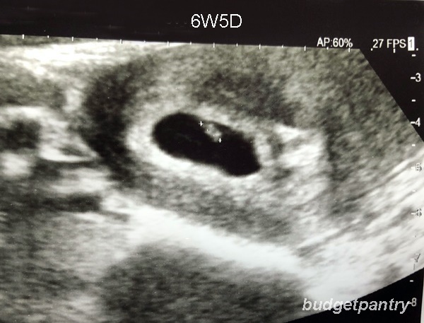 Pregnancy 2 A Flickering Heartbeat At My 6w5d Ultrasound Scan Budgetpantry Singapore Mummy Blog On Food Recipe Baby