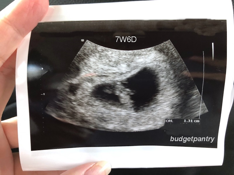 Pregnancy 2 A Flickering Heartbeat At My 6w5d Ultrasound Scan Budgetpantry Singapore Mummy Blog On Food Recipe Baby