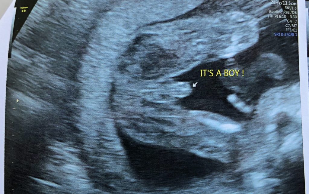 Ultrasound second trimester Pregnancy Ultrasounds